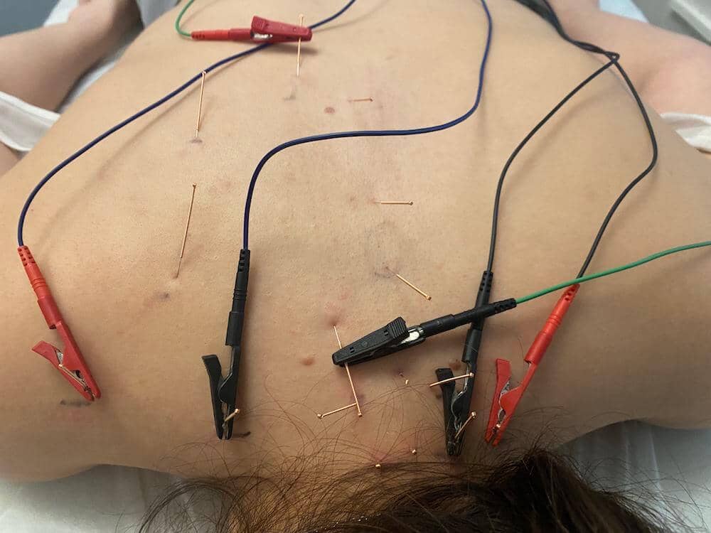 técnicas invasivas para osteopatas