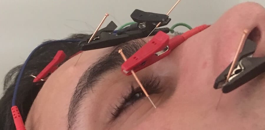 tratar paralisia facial com acupuntura