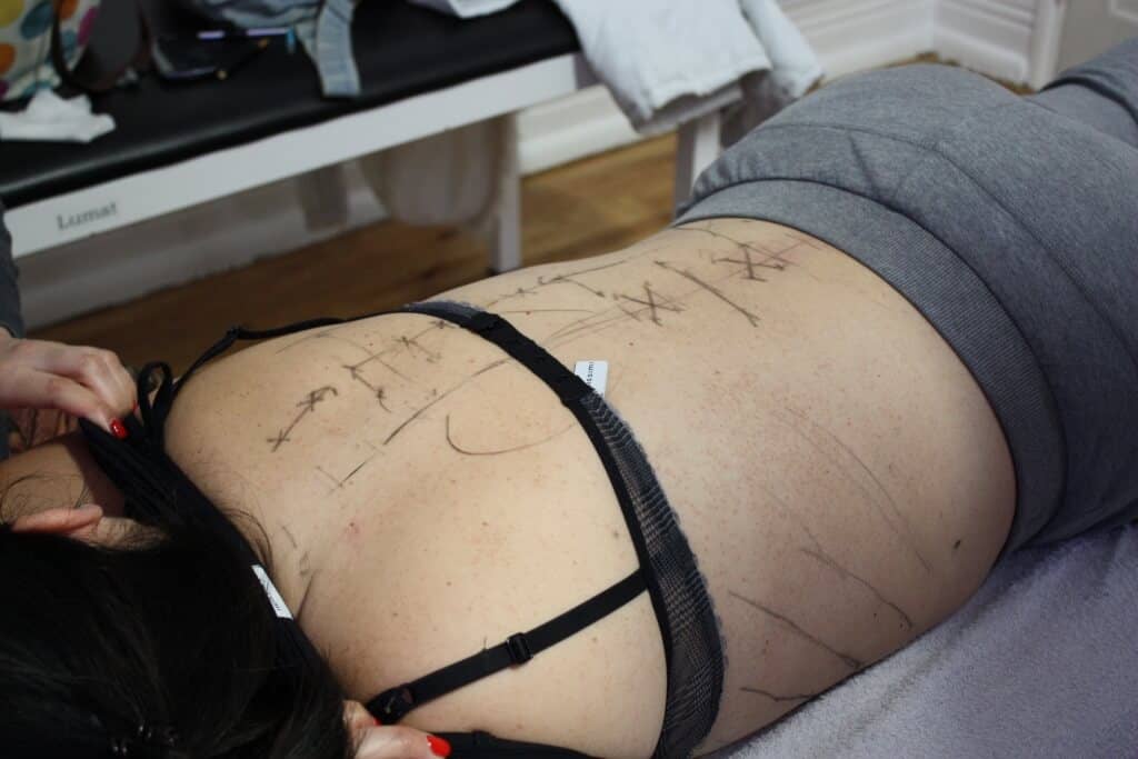 pontos de acupuntura nas costas
