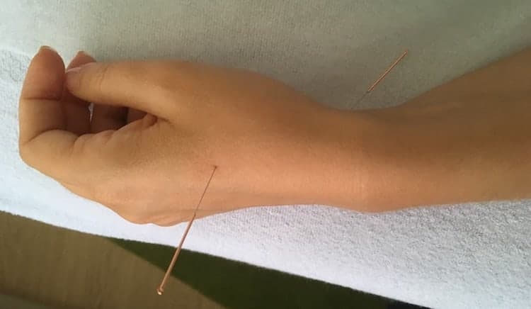 Dúvidas sobre tratamentos de acupuntura dedos dormentes
