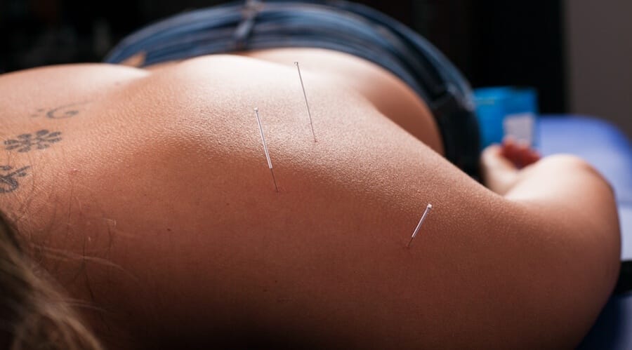 mitos da acupuntura em lisboa