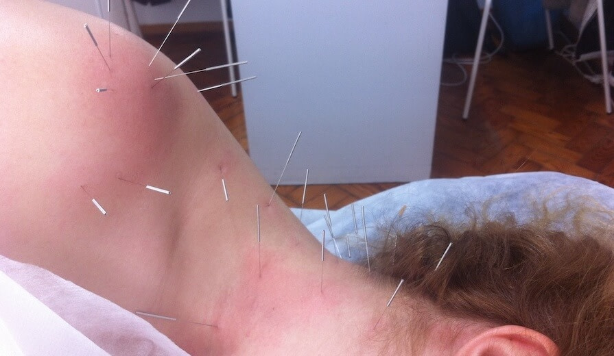 acupuntura é placebo dor